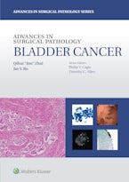 Advances in Surgical Pathology: Bladder Cancer