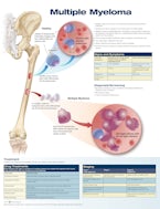 Multiple Myeloma Anatomical Chart