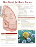 Non-Small Cell Lung Cancer