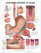 Understanding Ulcers Anatomical Chart