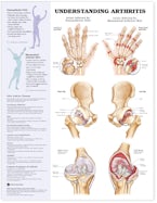 Understanding Arthritis Anatomical Chart