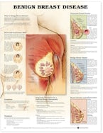 Benign Breast Disease Anatomical Chart