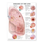Diseases of the Lung Anatomical Chart