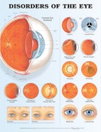 Disorders of the Eye Anatomical Chart