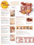 Understanding Skin Cancer Anatomical Chart by Anatomical Chart Company